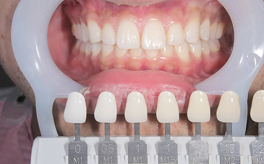 デュアルホワイトニングの施術後