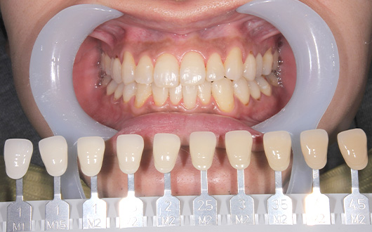 オフィスホワイトニングの施術後