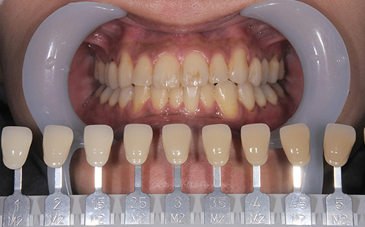 オフィスホワイトニングの施術前