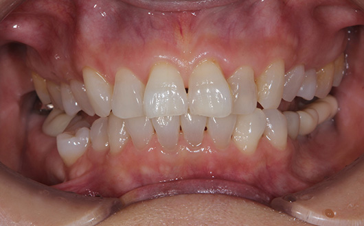 ホームホワイトニングの施術後