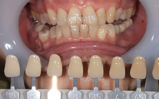 ホームホワイトニングの施術前